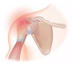 Image result for Frozen Shoulder
