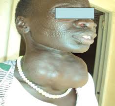 Image result for Goiter