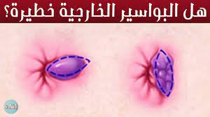 هل البواسير الخارجية خطيرة youtube