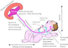 Image result for Delayed Transition from Fetal Circulation