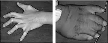 Poland syndrome is a disorder in which affected individuals are born with missing or underdeveloped muscles on one side of the body, resulting in abnormalities that can affect the chest, shoulder, arm, and hand. Camptodactyly Note The Flexion Deformity Of The Fingers In A Typical Download Scientific Diagram