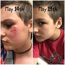 Herbs/Herb oils/creams for scars? Looking to reduce the appearance of  stretch marks. I have been doing straight vit E but Im curious if any herbs  can ramp up that vit E. Thanks!!!