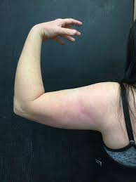 Coolsculpting + upper arms q&a. Before And After Coolsculpting Photos