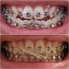 Maybe you would like to learn more about one of these? One Year With Damon Braces Braces
