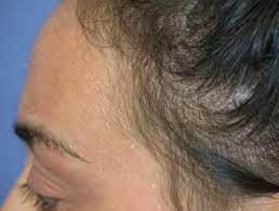 Hair loss from stress is not something that you'll notice immediately. Telogen Effluvium Dermnet Nz