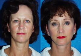 Stephen M. Krant, MD, FACS, Board Certified Plastic Surgeon