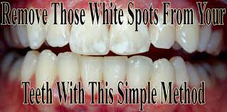 Teeth whitening with braces is one of the main concerns of people wearing braces and carring about how beautiful their you can check this complete guide on how to whiten your teeth after braces. Pin On Natural Remedies
