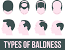 Type 2 Baldness