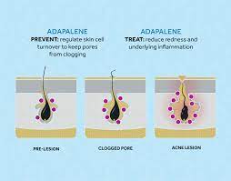 5 good reasons to stop using retinol and start using this instead What Is Adapalene Topical Retinoid For Acne Differin Gel