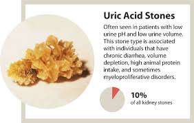 Kidney Stones A Marker Of Overall Kidney Health News Uab
