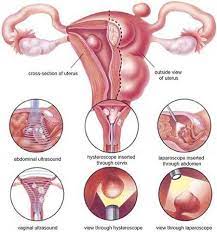 Hysteroscopic Myomectomy Fibroids Specialist Dr Mariz Nyc