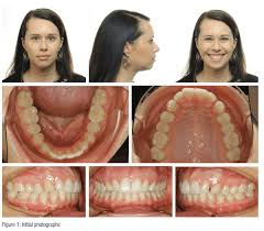 While there's no simple answer, we have a few suggestions to help. Gummy Smile An Often Untreated Condition Orthodontic Practice Us