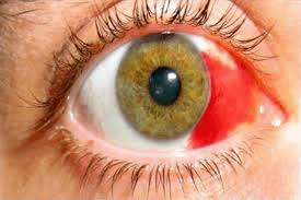 Image result for Eye Pain without Redness