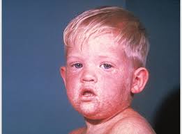 Disease Vaccination & Society Medical Innovation History