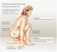 It's the most common type of arthritis in the uk. Arthrose Symptome Behandlung Und Vorbeugung