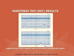 A nonstress test (nst) monitors your baby's heartbeat. Prenatal Period Pyramid Points Physical Assessment Findings In