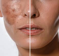 Image result for Hyperpigmentation