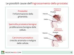 Prostata Ingrossata Sintomi Cause Cura Rischi Dieta E Rimedi Naturali