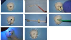 Maybe you would like to learn more about one of these? Removal Of Fiber Posts During Endodontic Retreatments Using Ultrasonic Tips A Comparison Between Two Different Endodontic Fiber Posts Sciencedirect