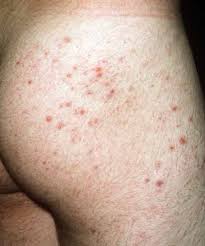 This process not only causes unsightly red bumps. Ingrown Hair Ingrown Hair Above Buttcrack