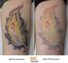 To cater to customers' pockets and preferences. Brigh And Bold With Heavy Color Saturation Usually Means Stubborn To Remove This Client Is Showing Amazing Pr Tattoo Removal Cost Nature Tattoos Laser Tattoo