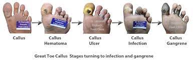 Cost effective treatment not spending even half of the amount. Podiatry Doctor Dr Somesh Diabetic Foot Clinic