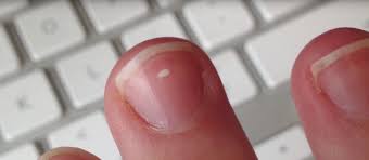 Healthy fingernails and toenails should be white as it grows off the nail bed and the nail plate a pinkish color. Why We Get White Marks On Our Nails