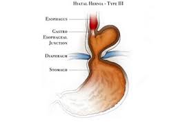 Hiatal Hernia Causes Symptoms And Treatment