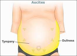 Ascites