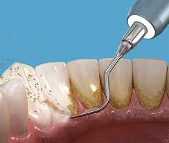 Use a hard toothbrush to clean the tartar off your teeth. What Is Tartar Dental Calculus How To Remove Tartar