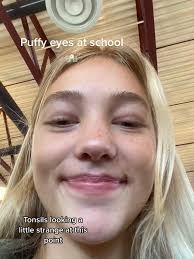 Swollen Eye from Mono