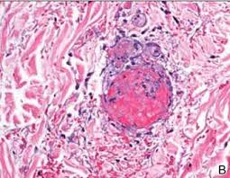 However, there are many options. Angioimmunoblastic T Cell Lymphoma Presenting As Purpura Fulminans Mdedge Dermatology