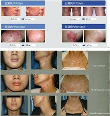 Uv Therapy Lamp Psoriasis Eczema Itchy Skin Vitiligo Therapy Uv Lamp With Fda Buy Dermatitis Ointment Uvb Lamp Psoriasis Vitiligo Uvb Lamp Product On Alibaba Com