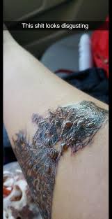 10 stars instead of 5. Week 2 Of My First Laser Tattoo Removal Popping