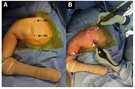 Image result for Snapping Scapula