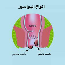 شكل البواسير الخارجية بالصور الحقيقية صحتنا