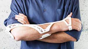 Healing Injuries Could Be Better Thanks To This 3 D Printed Cast 3d Printing Business Wearable Tech It Cast