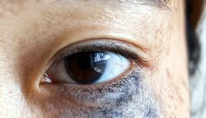 Image result for nevus sclerae
