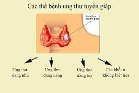 Thông tin thánh ăn yang soo bin phát hiện mắc ung thư tuyến giáp đã khiến cộng đồng mạng xôn xao. Ä'áº·t Lá»‹ch Pháº«u Thuáº­t Miá»…n Phi Ung ThÆ° Tuyáº¿n Giap Nguyen Nhan Va Cach Ä'iá»u Trá»‹