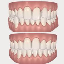 Maybe you would like to learn more about one of these? Invisalign Invisible Braces Clear Braces Invisalign Cost