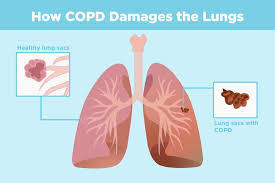 Lung attenuation vs lung function and dyspnea severity. Copd And Arthritis What S The Connection