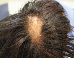 When a person has lichen planopilaris it will usually present itself as smooth areas hair loss from your scalp that is white. Lichen Planopilaris In A Patient Treated With Bexarotene For Lymphomatoid Papulosis Mdedge Dermatology