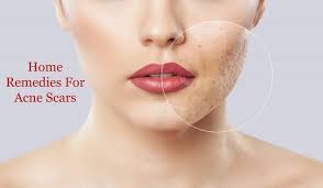 Check spelling or type a new query. How To Get Rid Of Acne Scars 12 Home Remedies Expert Bulletin