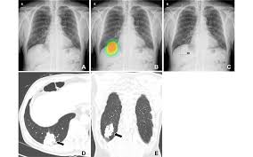 Image result for lung cancer xray