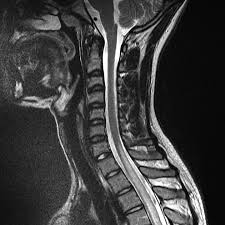 Image result for Myelitis