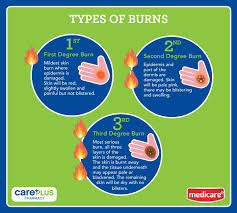 Submerge burn area immediately in cool water until pain stops. Facebook