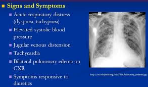 Image result for Transfusion Associated Circulatory Overload