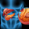 Pancreatic exocrine function tests should be done, but they do not differentiate chronic pancreatitis from pancreatic cancer. 1