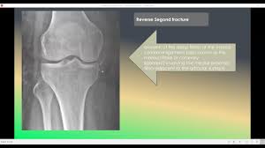 Image result for Segond Fracture