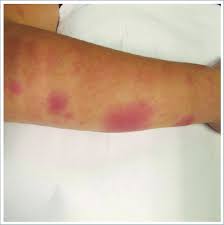 Image result for erythema nodosum